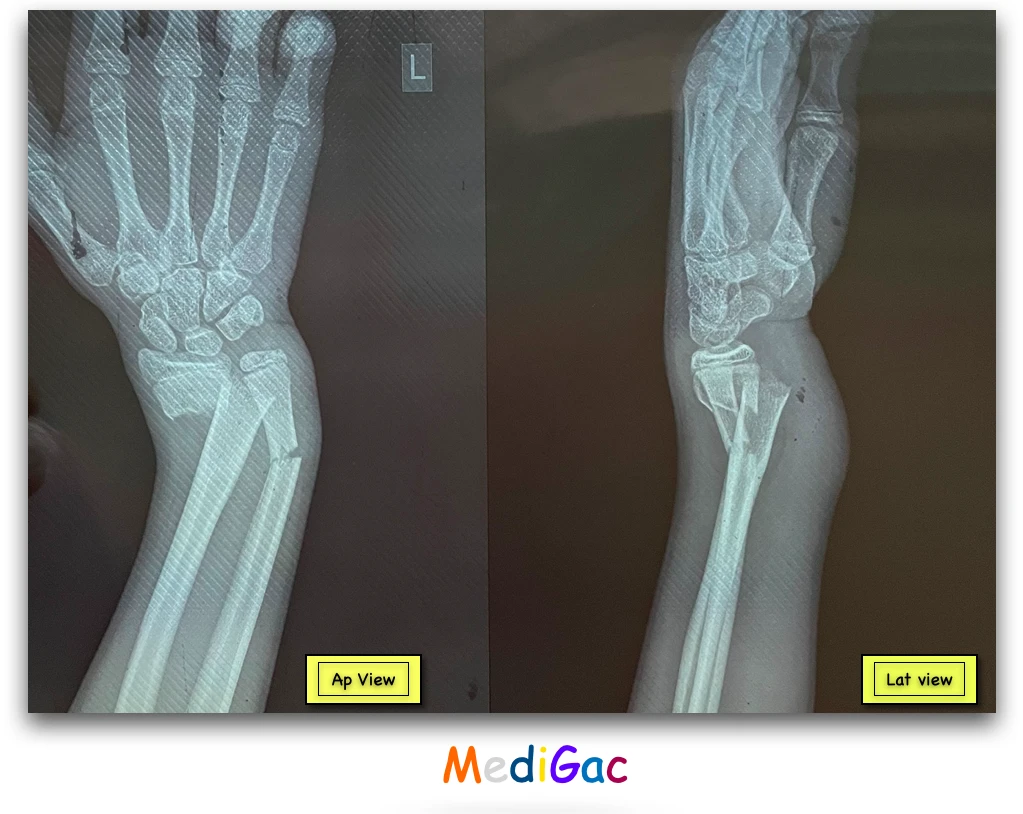 Ulnar fracture diagnosis